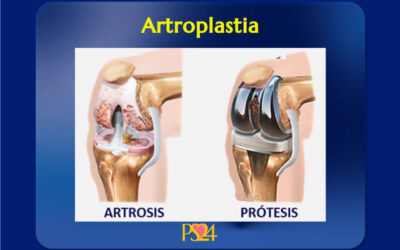 Artroplastia o reemplazo articular