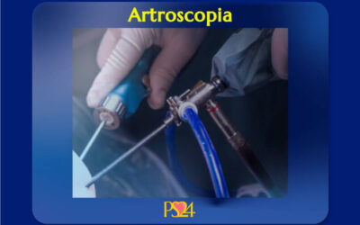 Artroscopia para tratar lesiones de Articulaciones