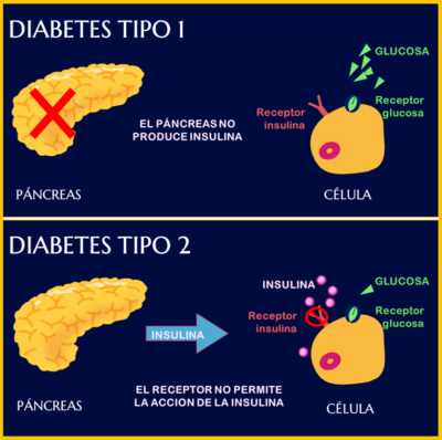 Diabetes y enfermedades relacionadas. | Academia de Pacientes 24 horas