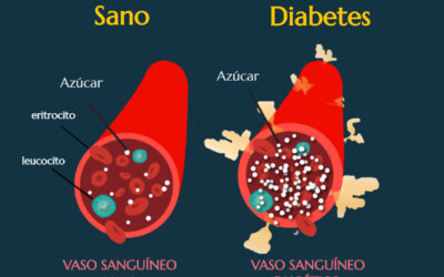 Diabetes y enfermedades relacionadas.