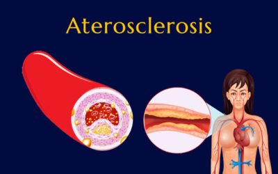 Aterosclerosis